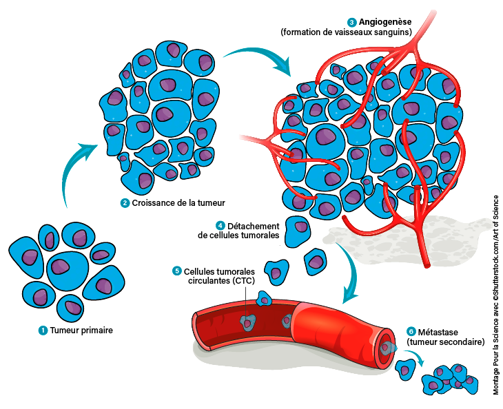 7 700 nouveaux cas de cancer enregistrés en Arménie chaque année